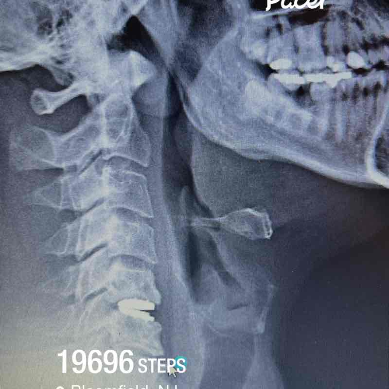 lumbar Spinal Fusion post 1