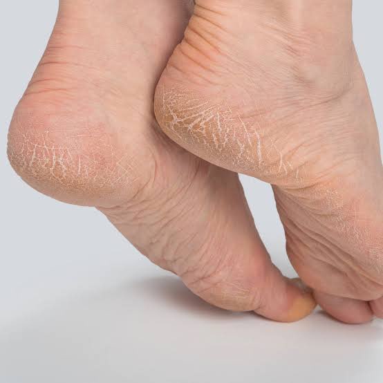 Cracked Heels icon